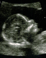 Emmett in the womb
